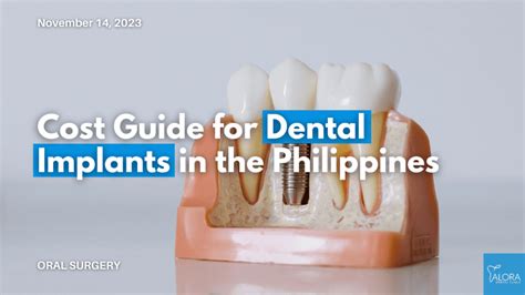 dental implants cost in the philippines|Affordable Dental Implants in the Philippines: A Guide for Patients.